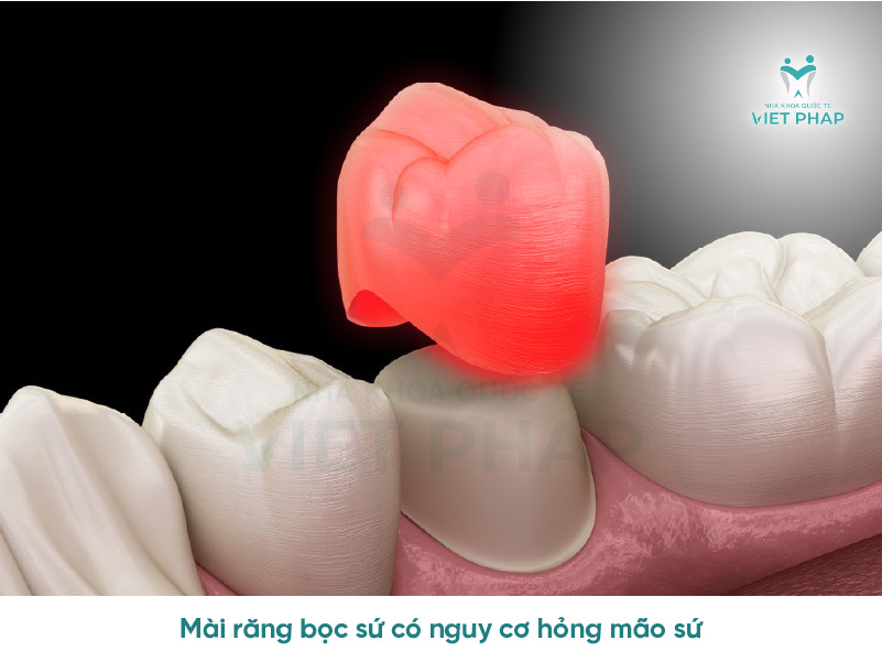 tac hai mai rang boc su 3 Mài răng bọc sứ có nguy cơ hỏng mão sứ