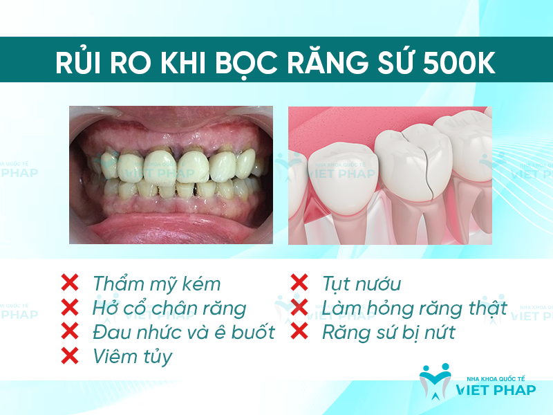 Các rủi ro khi bọc răng sứ 500k
