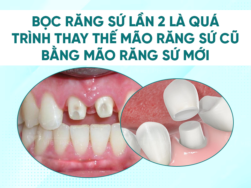 boc rang su lan 2 1 Bọc răng sứ lần 2 là thay mão sứ cũ bằng mão sứ mới