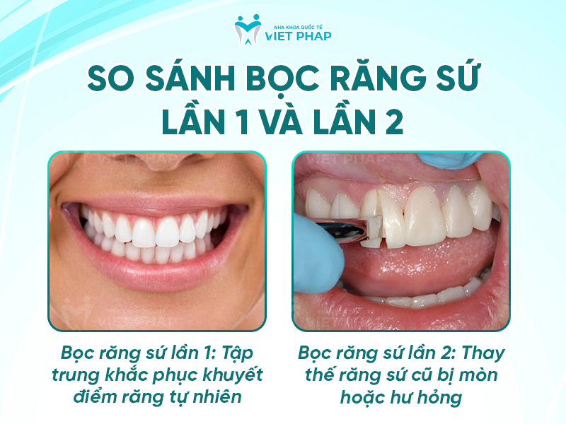 boc rang su lan 2 3 So sánh bọc răng sứ lần 1 và lần 2