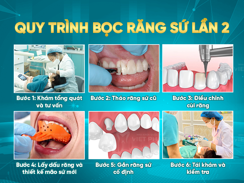 boc rang su lan 2 4 Quy trình bọc răng sứ lần 2