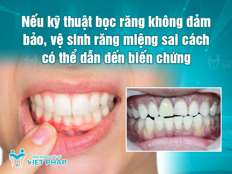 boc rang su lan 2 7 Bọc răng sứ không đúng kỹ thuật, vệ sinh sai cách có thể dẫn đến biến chứng