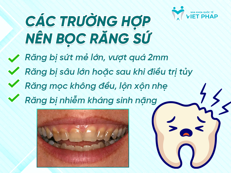 Các trường hợp nên bọc răng sứ