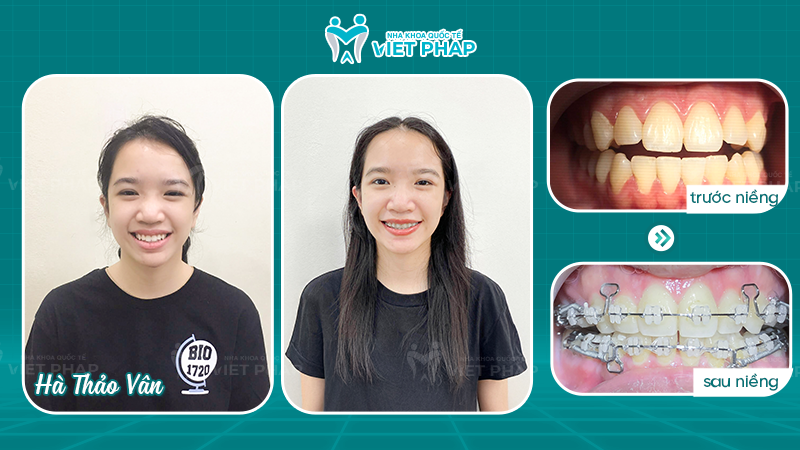 Ha Thao Van Hình ảnh trước và sau khi niềng răng của khách hàng Hà Thảo Vân