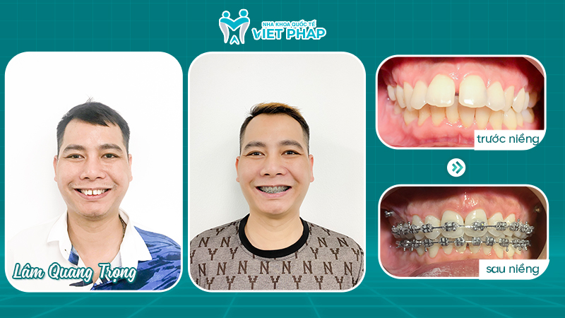 Lam Quang Trong 1 Hình ảnh anh Lâm Quang Trọng trước và sau khi niềng răng