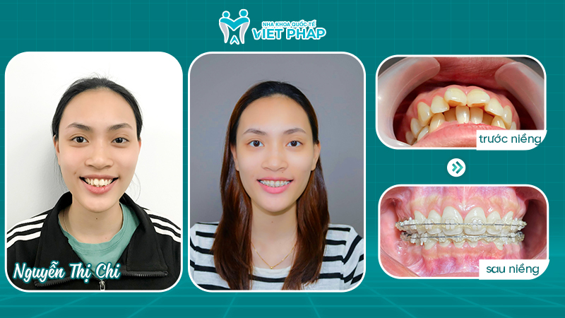 Khách hàng Nguyễn Thị Chi niềng răng trong suốt