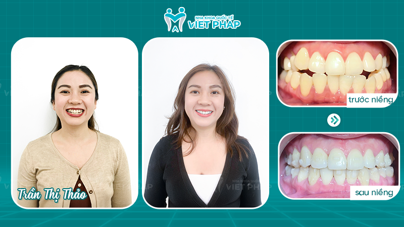 Tran Thi Thao Hình ảnh trước và sau khi niềng của chị Trần Thị Thảo