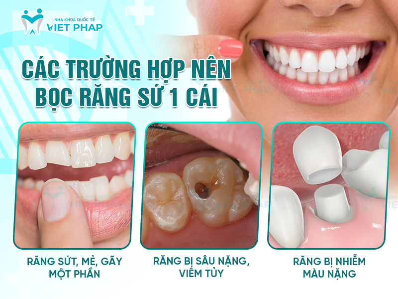 boc rang su 1 cai co duoc khong 2 Các trường hợp nên bọc răng sứ 1 cái