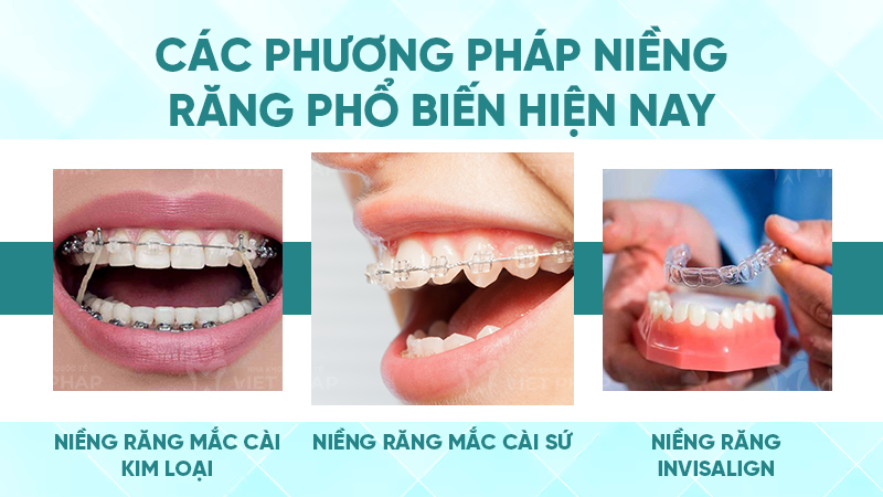 cac luu y khi nieng rang 2 Các phương pháp niềng răng phổ biến