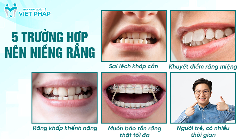 Trường hợp nên niềng răng 