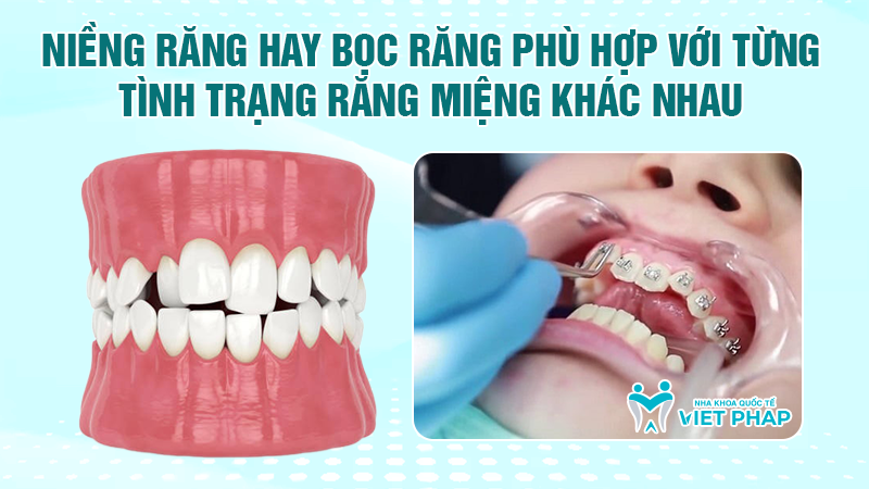 Niềng răng và bọc răng sứ đều là những giải pháp giúp cải thiện nụ cười