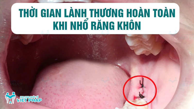 Thời gian lành thương hoàn toàn khi nhổ răng khôn