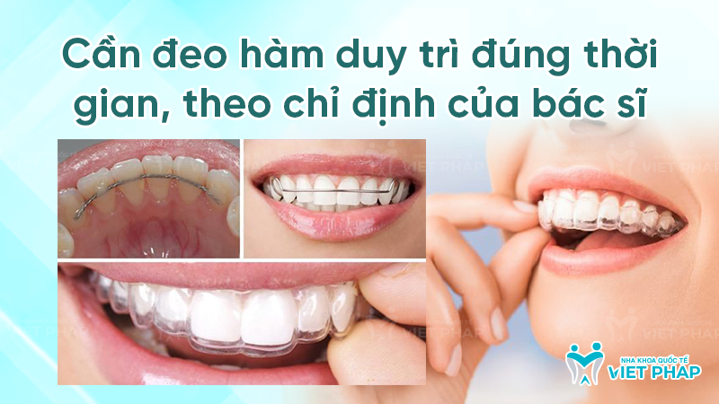 Cần đeo hàm duy trì đúng thời gian sau khi niềng răng