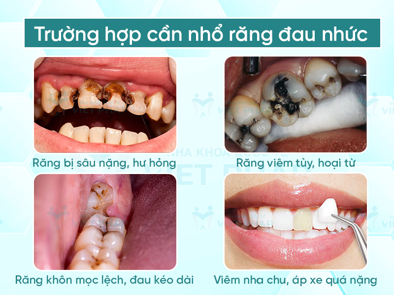 Tình trạng nào thì nên nhổ răng đau nhức?