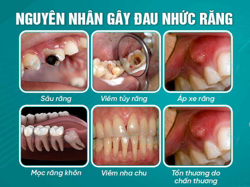 6 Nguyên nhân chính gây đau nhức răng