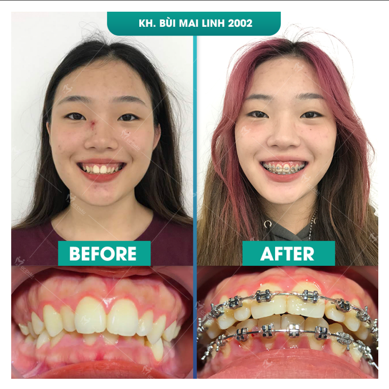 truoc va sau khi nieng rang bui mai linh Hình ảnh trước - sau khi niềng răng của khách hàng Bùi Mai Linh cho thấy sự thay đổi tích cực