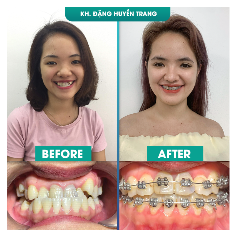 truoc va sau khi nieng rang dang huyen trang Hình ảnh trước và sau khi niềng răng cho thấy một giao diện hoàn toàn khác của chị Đặng Huyền Trang