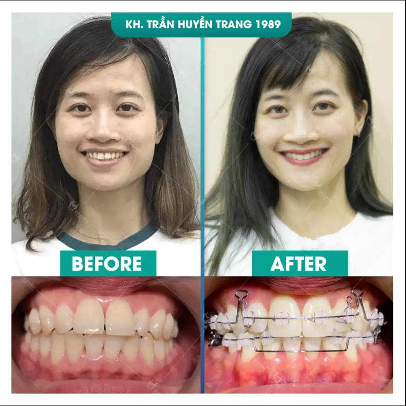 truoc va sau khi nieng rang tran huyen trang Chị Trần Huyền Trang có khuôn miệng nhỏ, răng đều và mũi trông cao hơn sau khi niềng răng