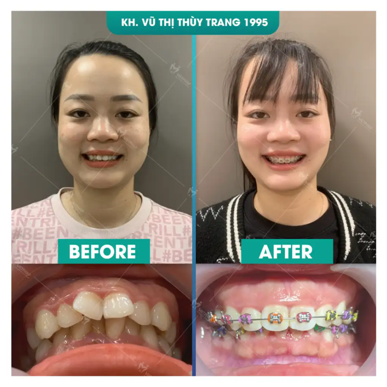 vu thuy trang sau khi nieng rang