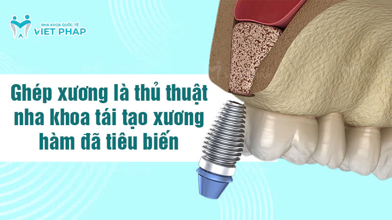 ghep xuong nha khoa quoc te viet phap 10 Ghép xương là thủ thuật nha khoa tái tạo xương hàm đã tiêu biến