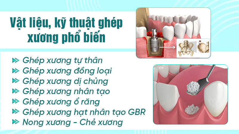 ghep xuong nha khoa quoc te viet phap 2 Các vật liệu và kỹ thuật ghép xương hiện nay