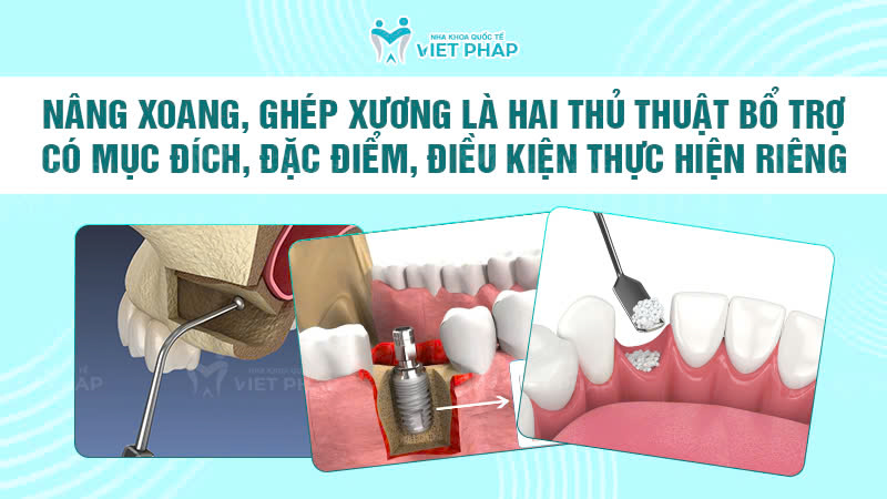 ghep xuong nha khoa quoc te viet phap 3 Nâng xoang, ghép xương là hai thủ thuật bổ trợ có mục đích, đặc điểm, điều kiện thực hiện riêng