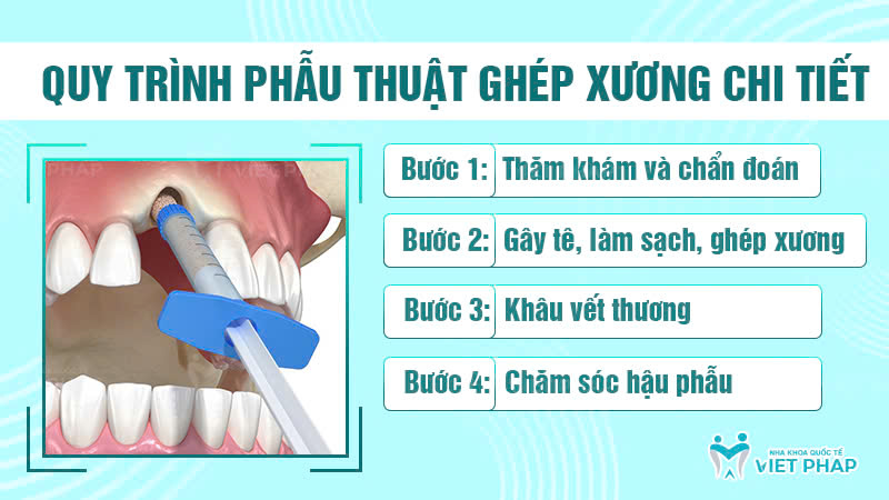 ghep xuong nha khoa quoc te viet phap 4 Quy trình phẫu thuật ghép xương