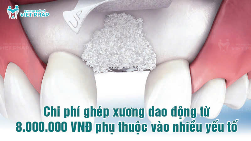 ghep xuong nha khoa quoc te viet phap 7 Chi phí ghép xương