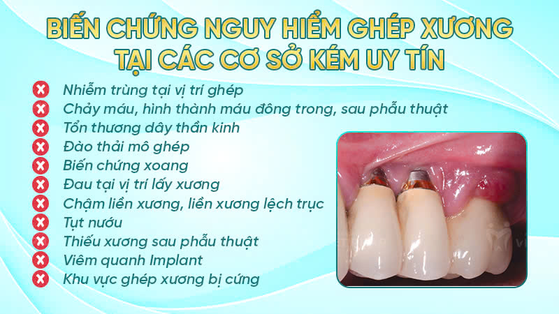 ghep xuong nha khoa quoc te viet phap 8 Biến chứng khi ghép xương tại các cơ sở kém uy tín
