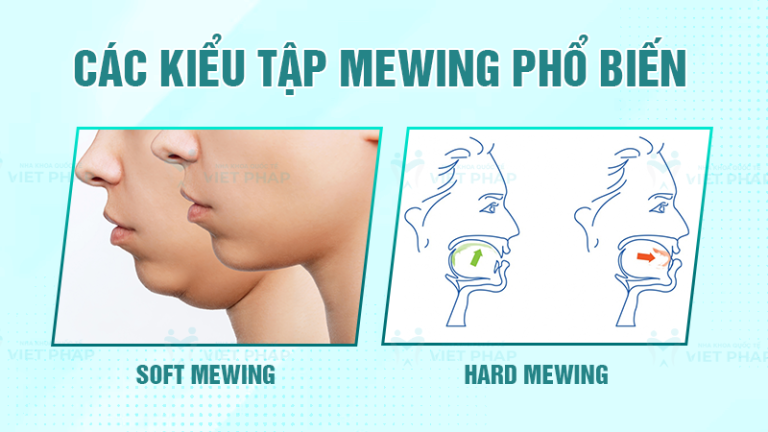 4 bước hướng dẫn Mewing và 5 bài tập hiệu quả ngay lần đầu tiên