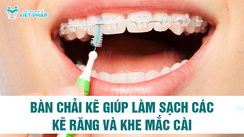 Bàn chải kẽ giúp làm sạch các kẽ răng và khe mắc cài