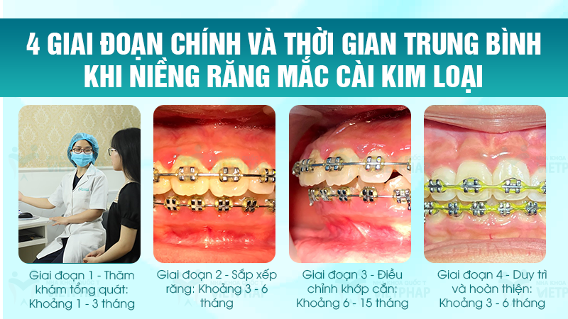 4 giai đoạn chính và thời gian trung bình khi niềng răng mắc cài kim loại
