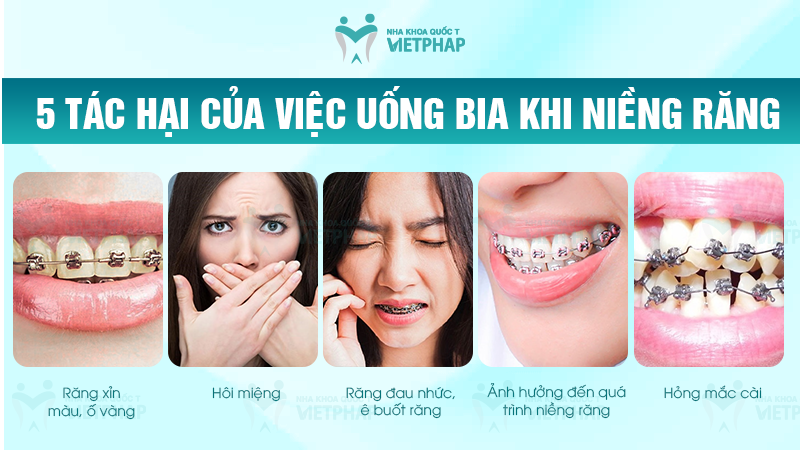 nieng rang uong duoc bia khong nha khoa quoc te viet phap 3 Tác hại của việc uống bia khi niềng răng