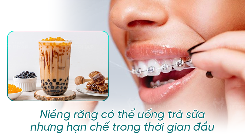 nieng rang uong duoc tra sua khong nha khoa quoc te viet phap 2 Niềng răng có thể uống trà sữa nhưng hạn chế trong thời gian đầu