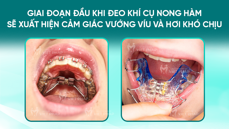 nong ham co dau khong 2 Cảm giác khi đeo khí cụ nong hàm