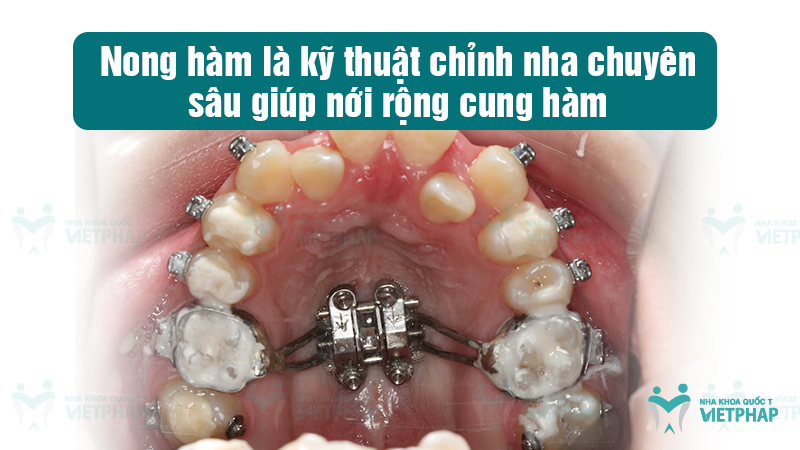 Nong hàm là kỹ thuật chỉnh nha chuyên sâu giúp nới rộng cung hàm