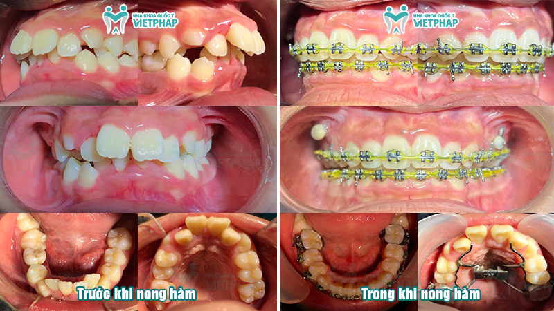 Hình ảnh nong hàm cận của Phương Linh trước và trong khi nong hàm