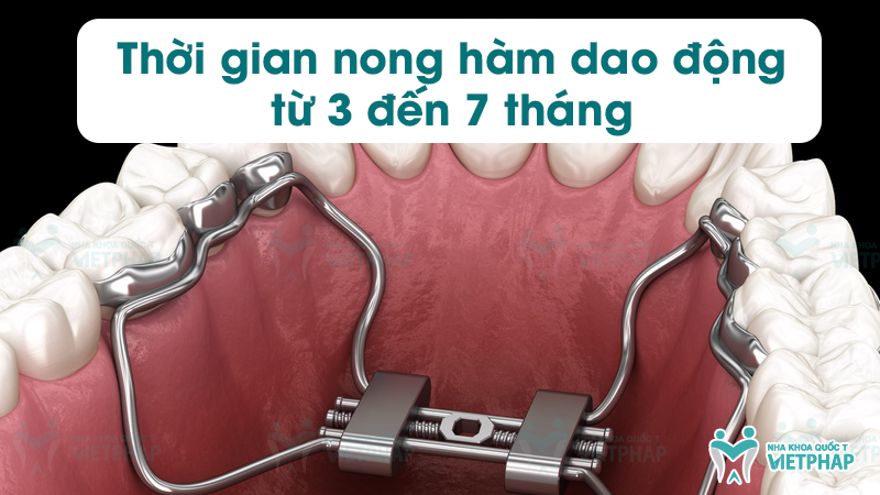 Thời gian nong hàm dao động từ 3 đến 7 tháng