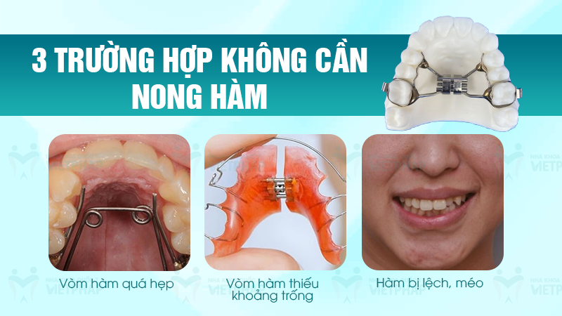 Những trường hợp cần nong hàm