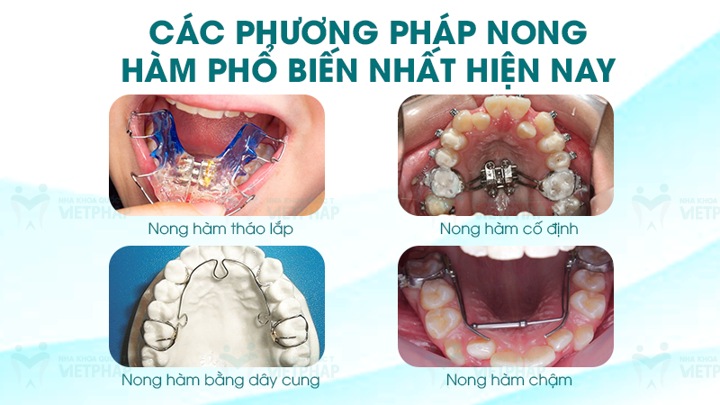 Các phương pháp nong hàm phổ biến hiện nay