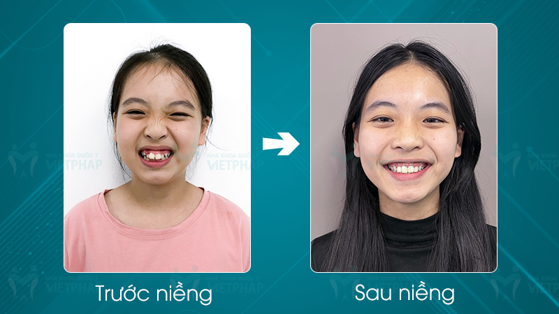 Hình ảnh Phương Linh trước và sau nong hàm cải thiện rõ rệt khớp cắn, tình trạng thưa, khấp khểnh
