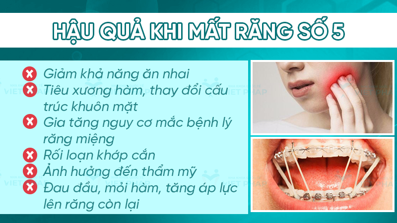 Hậu quả khi mất răng số 5