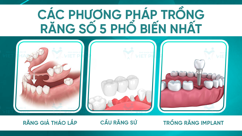 Các phương pháp trồng răng số 5 phổ biến nhất 
