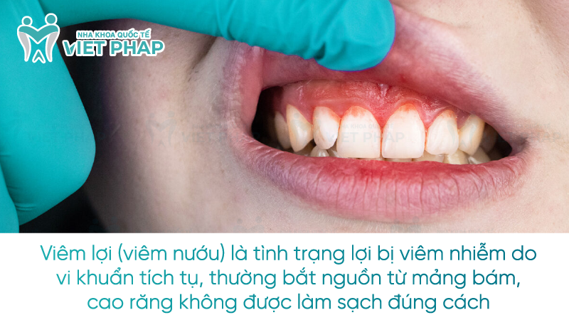 Viêm lợi (viêm nướu) là tình trạng lợi bị viêm nhiễm do vi khuẩn tích tụ, thường bắt nguồn từ mảng bám, cao răng không được làm sạch đúng cách