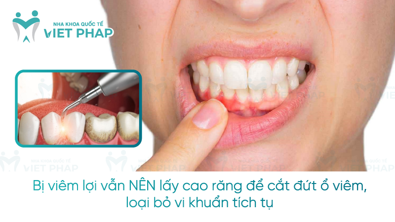 Bị viêm lợi vẫn NÊN lấy cao răng để cắt đứt ổ viêm, loại bỏ vi khuẩn tích tụ