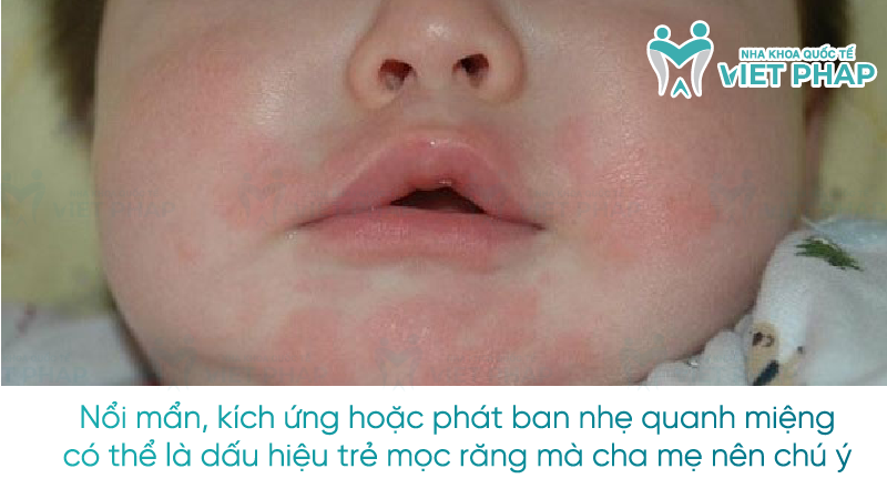 Dau hieu tre moc rang lan dau 3 Nổi mẩn, kích ứng hoặc phát ban nhẹ quanh miệng có thể là dấu hiệu trẻ mọc răng mà cha mẹ nên chú ý