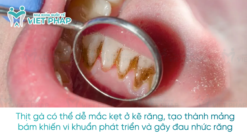Thịt gà có thể dễ mắc kẹt ở kẽ răng, tạo thành mảng bám khiến vi khuẩn phát triển và gây đau nhức răng 