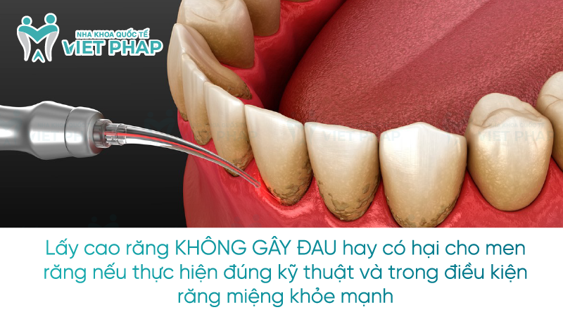  Lấy cao răng KHÔNG GÂY ĐAU hay có hại cho men răng nếu thực hiện đúng kỹ thuật và trong điều kiện răng miệng khỏe mạnh