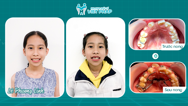 Khách hàng Lê Phương Linh trước và sau nong hàm