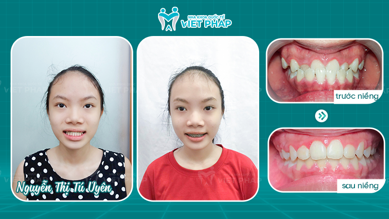 Nguyen Thi Tu Uyen Bé Nguyễn Thị Tú Uyên